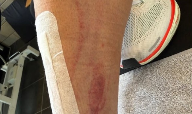NBA赛事-慎入！前德甲球员霍尔特比荷甲遭遇凶狠犯规，脚被划开一道口子
